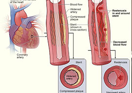 Cardiac Cath & Stenting Performed From The Wrist (Radial Artery)