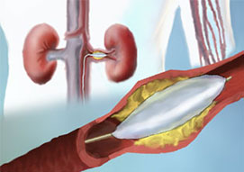 Renal Angiogram with Intervention