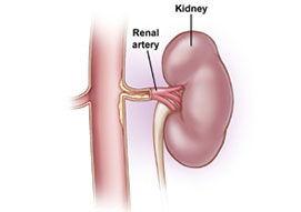 Renal Artery Duplex