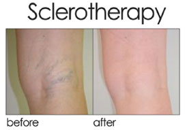 Liquid Sclerotherapy