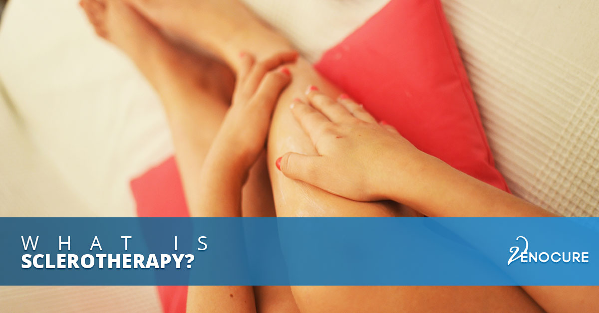 what is sclerotherapy