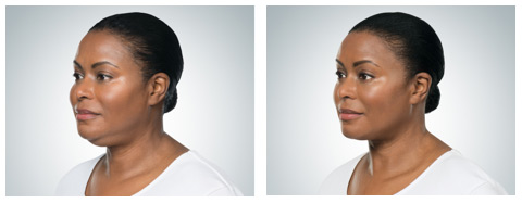 kybella-2