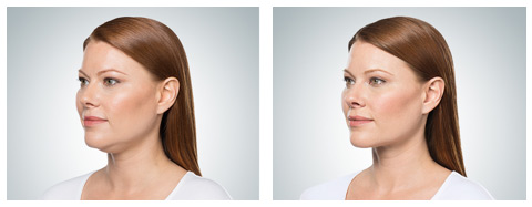 kybella-3