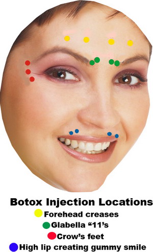 botox amp juvederm white smiles family dentistry botox injection sites