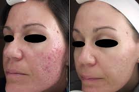 Japanese Doctors Successfully Treat Melasma Keloids With Laser Genesis Dreyfuss Plastic Surgery Chicago